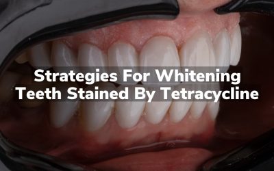 Strategies for Whitening Teeth Stained by Tetracycline